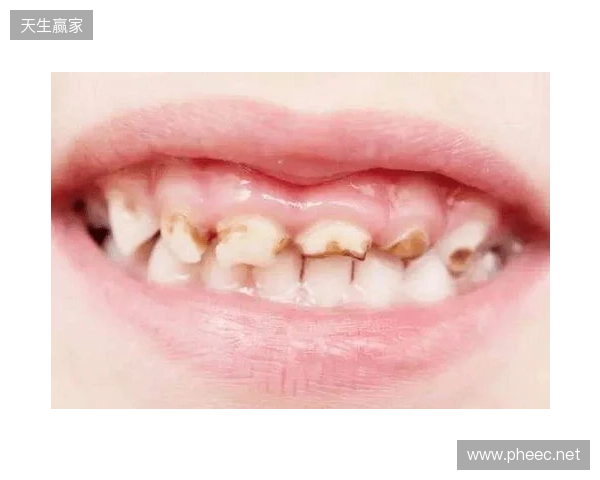 韦林顿确诊上唇部贯通伤;11、21牙半脱位;上颌前牙区牙槽骨骨折